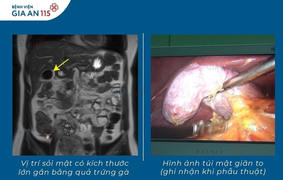 Người phụ nữ bất ngờ phát hiện sỏi mật 5cm, lớn gần bằng quả trứng gà