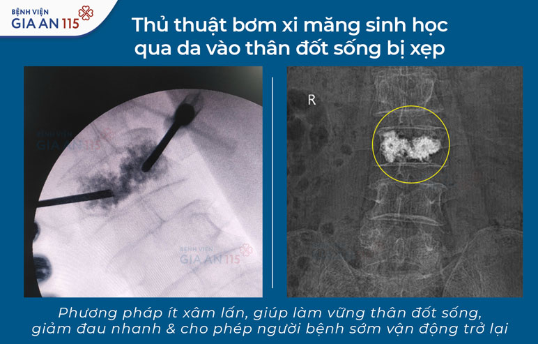 Ngã khi dọn nhà, người phụ nữ bị xẹp đốt sống thắt lưng