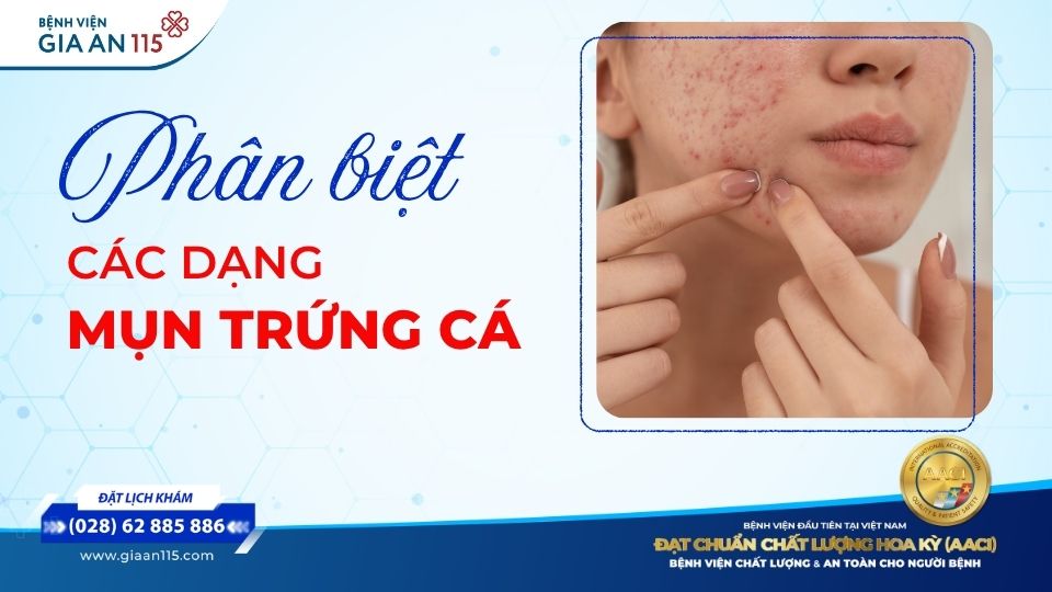 Các loại mụn trứng cá: Cách nhận biết và điều trị hiệu quả, hạn chế sẹo