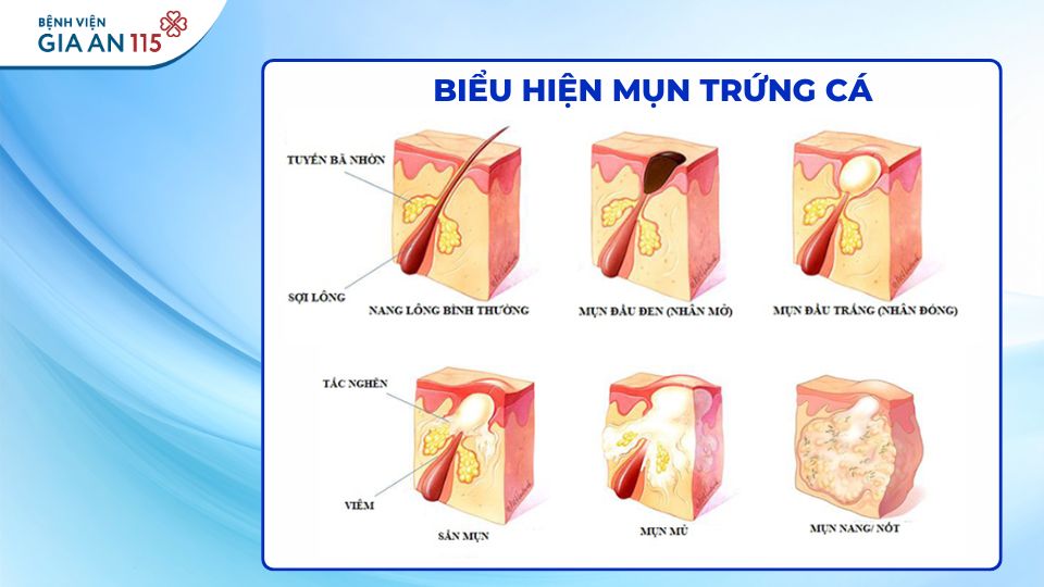 Các loại mụn trứng cá