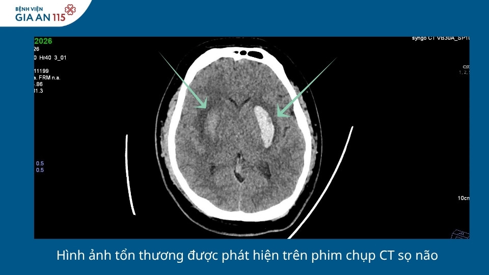 Đột quỵ tìm đến người trẻ: Nguy cơ từ béo phì và tăng huyết áp