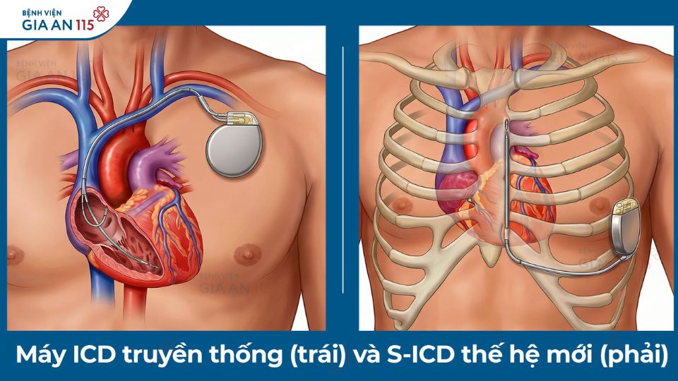 Lần đầu tiên tại Việt Nam cấy máy phá rung tim công nghệ mới cho bệnh nhân loạn nhịp tim phòng ngừa đột tử do tim