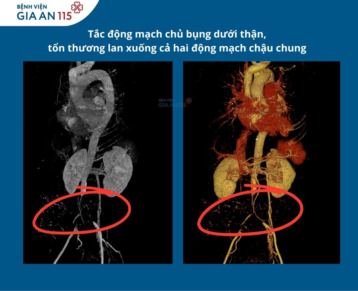 người phụ nữ phát hiện động mạch chủ bụng nuôi hai chân bị tắc hoàn toàn
