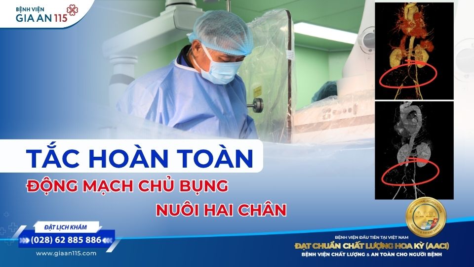 Đau chân tưởng thoái hóa khớp, người phụ nữ phát hiện động mạch chủ bụng nuôi hai chân bị tắc hoàn toàn