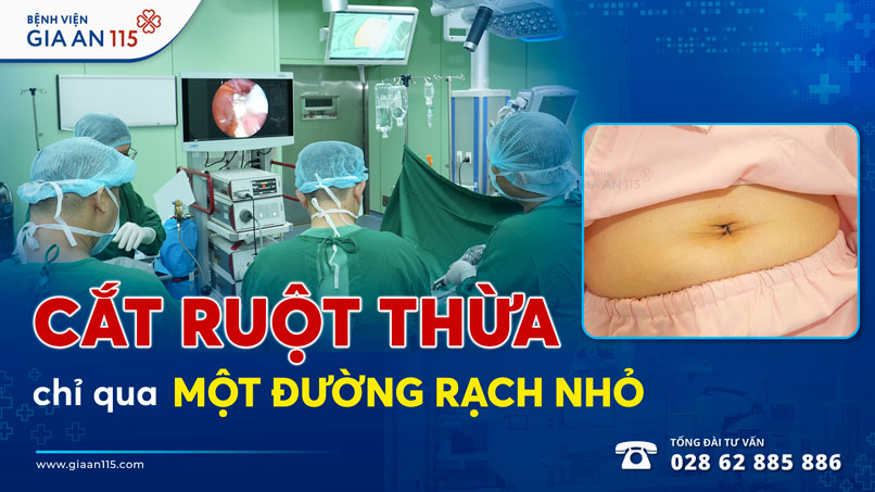 Cắt ruột thừa chỉ qua một đường rạch nhỏ cho người phụ nữ 46 tuổi
