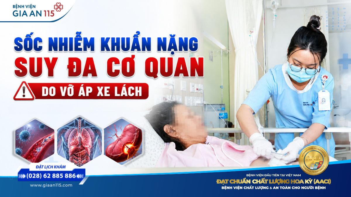 Sốt kéo dài, đau bụng âm ỉ… người phụ nữ 70 tuổi nguy kịch vì ổ áp xe lách vỡ