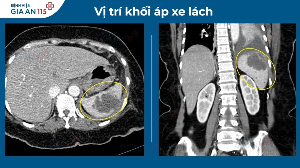 Sốt kéo dài, đau bụng âm ỉ… người phụ nữ 70 tuổi nguy kịch vì ổ áp xe lách vỡ