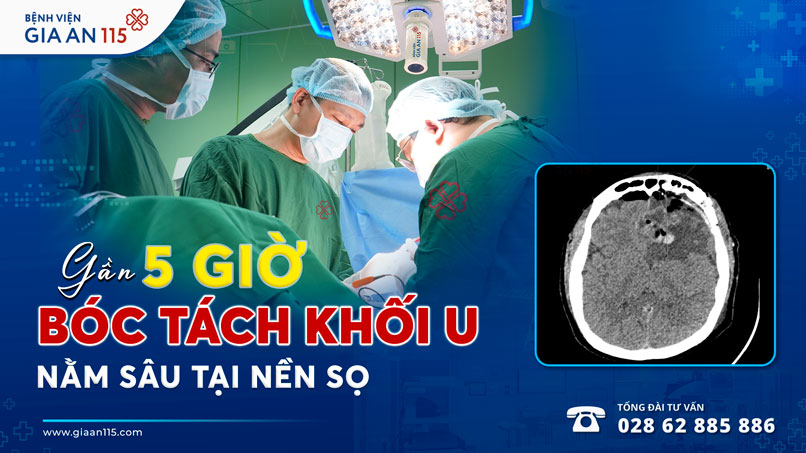 Gần 5 giờ bóc tách khối u nằm sâu tại nền sọ