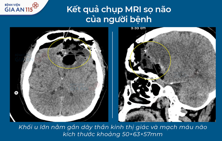 Kết quả chụp MRI sọ não ghi nhận khối u vùng củ yên – trên yên, kích thước khoảng 50 × 63 × 57 mm