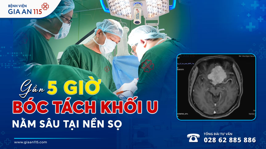 Gần 5 giờ bóc tách khối u màng não hơn 6 cm chèn ép đường dẫn truyền thị giác